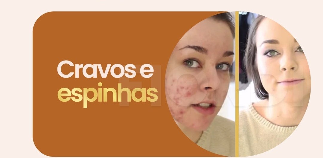 Antes e depois — cravos e espinhas cobertos pela Base Bella Aqua