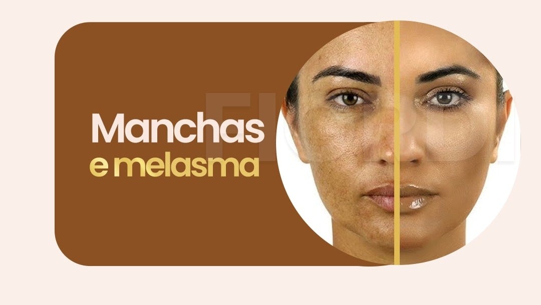 Antes e depois — manchas e melasma cobertos pela Base Bella Aqua