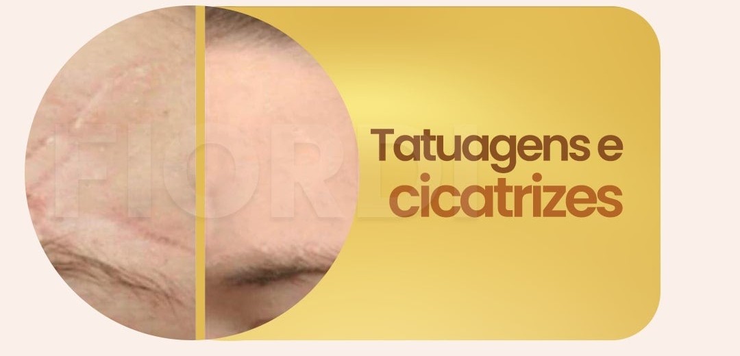 Antes e depois — tatuagens e cicatrizes cobertas pela Base Bella Aqua